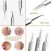 Professional Facial Blackhead Remover Tweezers,3Pcs Precision Pimple Popper Tool Kit for Whitehead Ance Blemishs Comedones Stainless Steel Makeup Tool - Glossy view 4