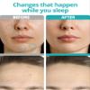 VILVIN Microdart Acne Patch - Zit Patches for Face - 27 ea - Fast Acting Blemish Cystic acne patches - Hyaluronic Acid, Tea Tree - Micropoint Pimple Patch view 4