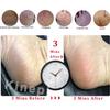 Kinepi Feet Callus Removers Professional Colossal Foot Scrubber Pedicure Foot File Foot Massager Pumice Stone for Feet,Remover Corn Hard Skin Dead Skin Exfoliator for Use in Shower Feet Care Tools view 4
