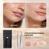SGNEKOO Professional Facial Milia Removal Tool and Whitehead Extractor,Titanium Alloy Double Ended Needle and Steel Tweezers Kit,Blackhead,Blemish,Zit and Pimple Acne Remover Popper (Titanium Gold) view 2