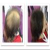 CABOKI VALUE PACK 1, 2x30G Hair Building Fibers Plus Hair Fiber Spray. 180-Day supply, Dark Brown view 3