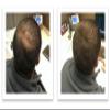 Hide Bald Spots and Bald Edges Instantly. Make Thin Hair Look 10X Fuller. Caboki Hair Fiber Starter Kit (Dark Brown) view 4