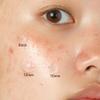 Epielle Over-Zit Acne Clear Patches 138 Count, Hydrocolloid Acne Pimple Patch for Covering Zits and Blemishes view 3