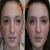 Ane Lumiere Jessner Chemical Peel Kit view 2