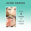 Celesty Beauty Facial Acne Cleanser Gel Deep Face Pore Cleansing, Large 6.7 oz view 2