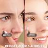 Albatross Health New England Invisible Pimple Patches for face, plain Hydrocolloid Acne Patches, HSA FSA eligible, Spot Dots Cover, Zit Blemish Patch, 2 Sizes 180 Counts view 2