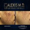 ALEXIS M.D. Acne Cleanser | 100ml | 3.3oz view 3