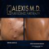 ALEXIS M.D. Acne Cleanser | 100ml | 3.3oz view 4