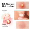 Pimple Patches, 15 mm Invisible Acne Patches for Face with Salicylic Acid, 0.01cm Extra Thin Outer Edge, Hydrocolloid Zit Patch for Pustule, Whitehead, Cystic Acne Spot, 48 Count view 4