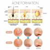 Blackhead Remover 9 Pcs Stainless Steel Pimple Popper Tool Kit Whitehead Blemish Removal Tool Comedone Extractor with Portable Bag view 2