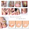 5PCS Stainless Steel Ingrown Toenail Pedicure Knife Set, IngrownToenail Corrector for Thick Ingrown Nail Callus view 4