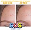 SOS SAVER OF SKIN, Blemish Patches, Fast Working Hydrocolloid Acne Patches for Covering Pimples, Zits, and Blemishes on Face and Skin, Absorb Fluids, Latex Free, Vegan (80, Transparent) view 3