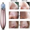 RMENST Blackhead Removal Pore Vacuum, Facial Pore Cleaner, Acne Whitehead Remover, Blackhead Remover Vacuum with 4 Probes for Women & Men view 2