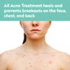 All Acne Treatment - Face and Body - Spot and Full Coverage - Gel Formula - 9 Skin Boosters view 2
