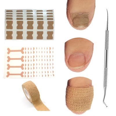 Ingrown Toenail Treatment, Ingrown Toenail Removal Kit, 50pcs Ingrown Toenail Correction Stickers, 50pcs Toenail Corrector Patches, 1pcs Toenail File And Lifter, 1 Roll of Glue-Free Toe Protector