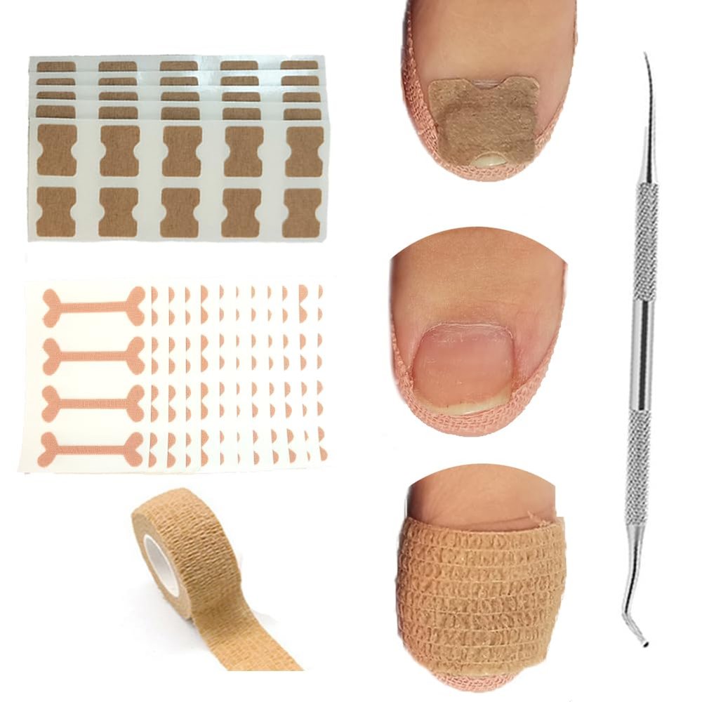 Ingrown Toenail Treatment, Ingrown Toenail Removal Kit, 50pcs Ingrown Toenail Correction Stickers, 50pcs Toenail Corrector Patches, 1pcs Toenail File And Lifter, 1 Roll of Glue-Free Toe Protector