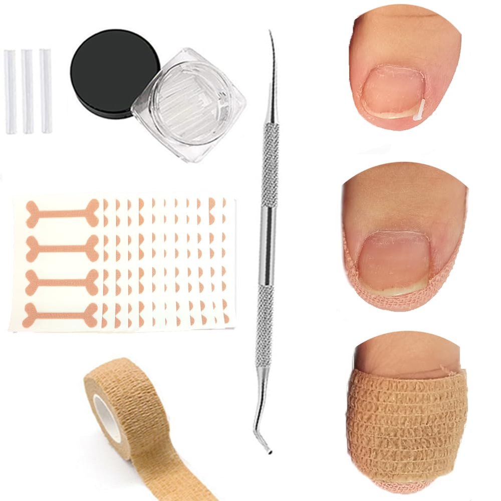 Ingrown Toenail Treatment, Removal Kit, 50pcs Transparent Ingrown Toenail Corrector Strips, 50pcs Toenail Corrector Patches, 1pcs Ingrown Toenail File And Lifter, 1 Roll of Glue-Free Toe Protector