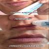 Lip Line Serum For Lines Above the Lips, Max Strength, With Hyaluronic Acid, Papaya Extract and Retinol view 3