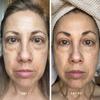 Droplette Ultra Micro-Infuser Skincare Device - Micro-Mist Technology for 20x Deeper Serum Delivery (Collagen, Retinol, Tranexamic Acid) - Clinically Tested, Improves Hydration & Reduces Fine Lines view 3