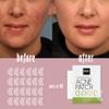 GREIGHT BRAND PRODUCTS Hydrocolloid Large Acne Patches for Cheek & Chin - 80 Pieces - Extra coverage For Breakout, Conceals Acne, Reduces Pimples and Blackheads view 4
