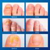 Toenail Fungus Treatment Extra Strength - Nail Fungus Treatment For Toenail Extra Strength - Nighttime Nail Patches & Nail Treatment Liquid Set (32patches+15ml) view 3