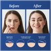 2 Pack - Dr Smooth Skin Acne Patch, 36 Hydrocolloid Patches, Blemish Remover, Acne Remover, 2 Size Patches 8mm, 12mm (2 Pack) view 2