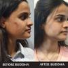 Buddha Natural Anti Acne Face Wash - Combat Acne, Nourish, Hydrate And Promote Clear Skin | Ideal For Oily Skin - Anti Acne Face Wash For Oily Skin view 2