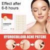 Pack of 144 Hydrocolloid Acne Patch Makeup Acne Patch Zit Patches for Cystic Acne Blemish view 2