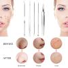 Blackhead Remover 8PCS Stainless Steel Pimple Popper Tool Kit with Portable Metal Case Whitehead Blemish Removal Tool view 3