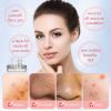 Blackhead Remover 8PCS Stainless Steel Pimple Popper Tool Kit with Portable Metal Case Whitehead Blemish Removal Tool view 4
