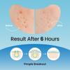 DERMA ANGEL Large Pimple Patches for Nose Chin and Forehead Pores Breakout and Spot Treatment - Acne Patches for Face Hydrocolloid Acne Patches Zit Patches for Face Big Pimple Patches - 16 Patches XL view 2