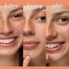 LeSpot Pimple Patches for Face  Zit Patches for Face That Stay in Place, Effective Hydrocolloid Acne Patches, Blemish Patches That Work, Acne Dots, 76 Count view 2