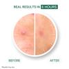 YOUR Improving Acne Patches: Ultra-thin Hydrocolloid Pimple Patch for Face; Purifies & Alleviates Stubborn Blemishes, Promotes Healing, Effective Zit Treatment. Made in USA. 56 Count view 2