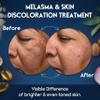 Melasma Treatment for Face - Melasma Cream & Age Spot Remover for Skin Discoloration, Post-Blemish Marks, Scars & Spots | Dark Spot Remover for Face & Body view 3