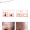 KouRy Blackhead Remover Pore Vacuum Cleaner Acne Comedo Extractor,USB Rechargeable Blackhead Suction Tool with 4 Probes and 4 Adjustable Suction Level,Easy to use Ideal Gifts for Women view 2