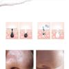 KouRy Blackhead Remover Vacuum, Electric Pore Cleaner Blackhead Acne Extractor USB Rechargeable Display for Facial Skin Suitable for Family, Travel use view 4