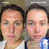 Codex Labs Shaant Spot Hero  Sulfur & Green Tea Gel for Blemish-Prone Skin | Fast-Drying Formula for Clear-Looking Skin | 0.5oz view 3
