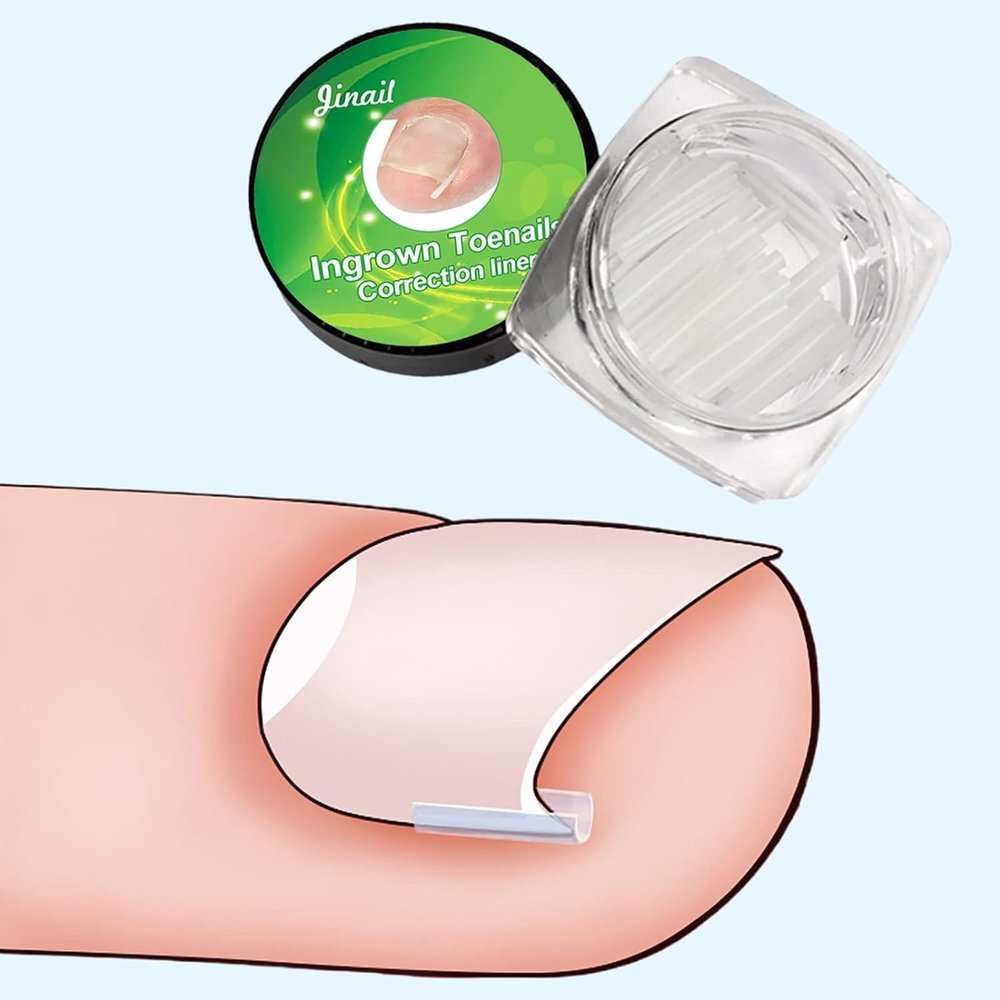 10Pcs White Ingrown Toenail Correction Strips Brace Kit, Ingrown Toenail Corrector Straightener Strips Recover Toenails Thick Pedicure Tool Toenail Straightener Strip for Men Women Foot Care Tool