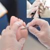 Stainless steel ingrown toenail pedicure knife set,professional foot skin scraper repair sharp blade kit for nail corn callus paronychia treatment. (2) view 3