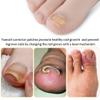 Ingrown Toenail Corrector Patch, 100 Pcs, No Glue & Breathable, 0.5"Wx0.7"L view 3