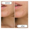 Skincureation Acne Pimple Patches (60 Counts 1 Size)  Invisible Hydrocolloid Acne Patch with Aloe and Tea Tree Oil for Covering Zits and Blemishes view 4
