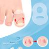 FILFEEL 10 Pcs Ingrown Toenail Corrector Ring, Silicone Ingrown Toe Correcting Nail Correct Brace Ring - Stretch Resistant, Reusable view 4