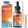 Ingrown Toenail Relief: Ingrown Toenail Tool for Men Women - Ingrown Toenail Removal Kit - Ingrown Toenail Corrector Drops - Ingrown Toenail Removal - Effective Solution for Ingrown Toenails - 30ml view 1