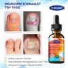Ingrown Toenail Relief: Ingrown Toenail Tool for Men Women - Ingrown Toenail Removal Kit - Ingrown Toenail Corrector Drops - Ingrown Toenail Removal - Effective Solution for Ingrown Toenails - 30ml view 2