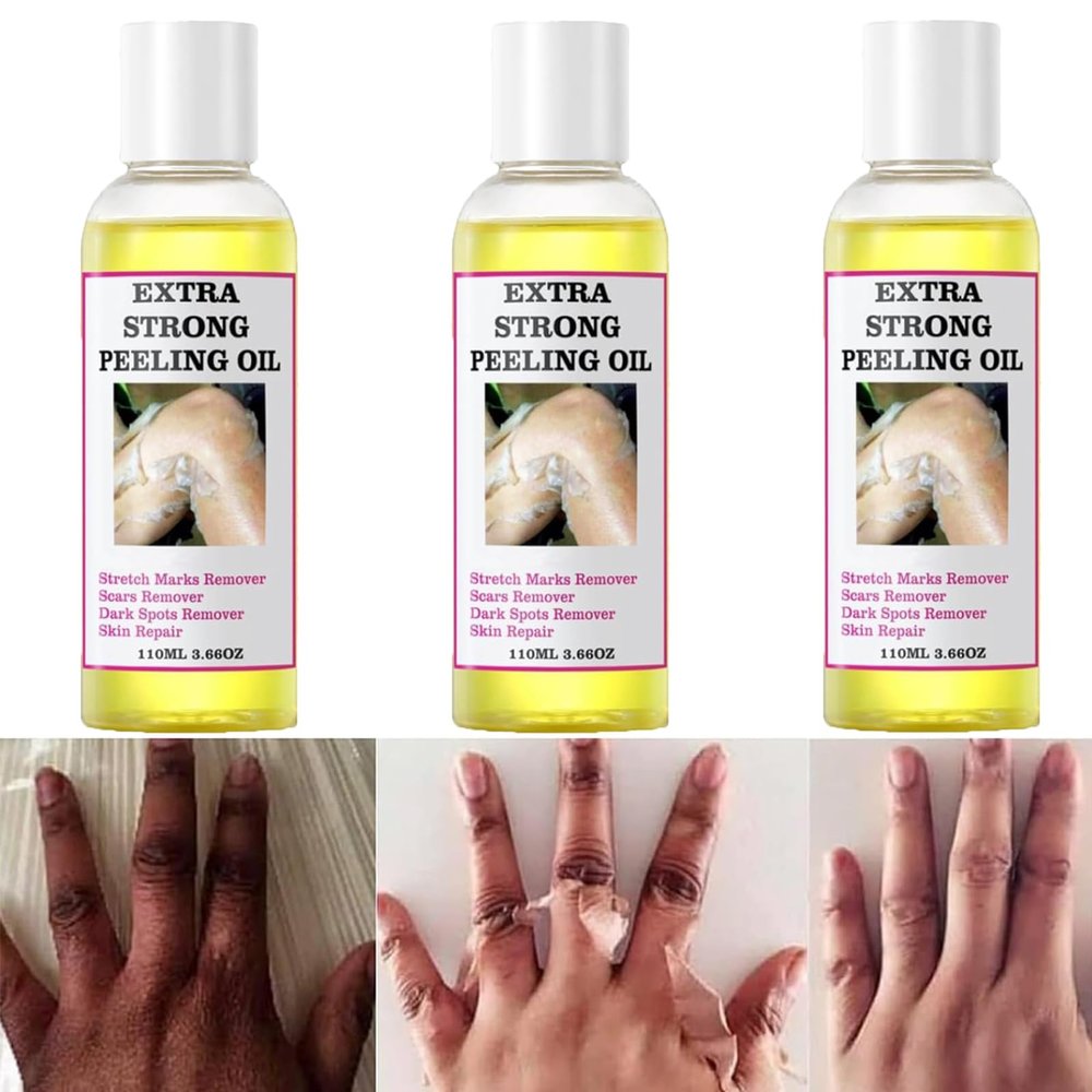 NinthAvenue Basics Extra Strong Yellow Peeling Oil for Dark Skin, Exfoliating Solution for Body, Hand, Feet and Face - All Skin Types (330ML/11.7 Fl Oz)