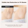 LYSMOSKI Laser Hair Removal for Women and Men, Safe at-Home Hair Removal Device, Hair Laser Removal with Long-Lasting in Hair Reduction for Armpits Back Legs Arms Face Bikini Line view 2