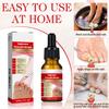 2PCS Ingrown toenail drops,Ingrown Toenail Relief,Easy Trim Ingrown Toenail Tools,Toenail Fluid With Silicone Gel Toe Caps Essential Oil Diffuser,Ingrown Toenail Reliever and Softener Kit view 4