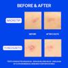 KNEMO Right Away Duo, Microtip Hydrocolloid Acne Pimple Patch and Thincognito Invisible Spot Patch view 3