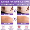Silicone Scar Sheets, Medical Grade Silicone Scar Tape (1.6" x 120"), Professional Scar Removal Treatment, Reusable, for Healing Keloids, Surgeries Scars, C-sections, and Burns view 4