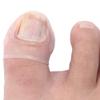 2pcs Ingrown Toenail Correction Silicone Toenail Corrector Pedicure Paronychia Correction Tool view 4
